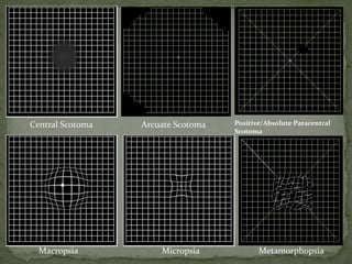 MetamorphopsiaMicropsiaMacropsia
Positive/Absolute Paracentral
Scotoma
Arcuate ScotomaCentral Scotoma
 