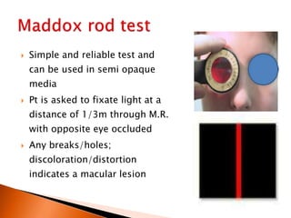  Simple and reliable test and
can be used in semi opaque
media
 Pt is asked to fixate light at a
distance of 1/3m through M.R.
with opposite eye occluded
 Any breaks/holes;
discoloration/distortion
indicates a macular lesion
 