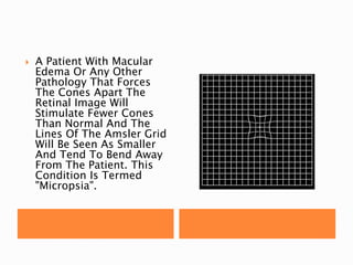  A Patient With Macular
Edema Or Any Other
Pathology That Forces
The Cones Apart The
Retinal Image Will
Stimulate Fewer Cones
Than Normal And The
Lines Of The Amsler Grid
Will Be Seen As Smaller
And Tend To Bend Away
From The Patient. This
Condition Is Termed
"Micropsia".
 