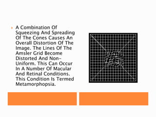  A Combination Of
Squeezing And Spreading
Of The Cones Causes An
Overall Distortion Of The
Image. The Lines Of The
Amsler Grid Become
Distorted And Non-
Uniform. This Can Occur
In A Number Of Macular
And Retinal Conditions.
This Condition Is Termed
Metamorphopsia.
 