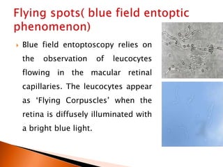 Blue field entoptoscopy relies on
the observation of leucocytes
flowing in the macular retinal
capillaries. The leucocytes appear
as ‘Flying Corpuscles’ when the
retina is diffusely illuminated with
a bright blue light.
 