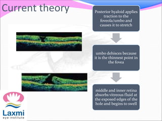 Current theory Posterior hyaloid applies
traction to the
foveola/umbo and
causes it to stretch
umbo dehisces because
it is the thinnest point in
the fovea
middle and inner retina
absorbs vitreous fluid at
the exposed edges of the
hole and begins to swell
 