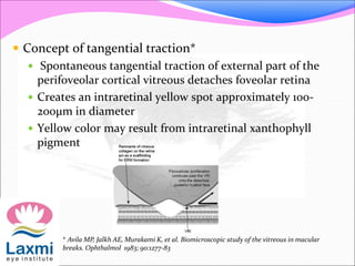  Concept of tangential traction*
 Spontaneous tangential traction of external part of the
perifoveolar cortical vitreous detaches foveolar retina
 Creates an intraretinal yellow spot approximately 100-
200μm in diameter
 Yellow color may result from intraretinal xanthophyll
pigment
* Avila MP, Jalkh AE, Murakami K, et al. Biomicroscopic study of the vitreous in macular
breaks. Ophthalmol 1983; 90:1277-83
 