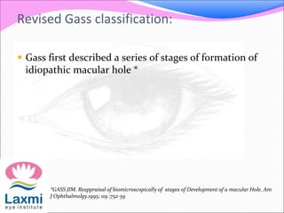Revised Gass classification:
 Gass first described a series of stages of formation of
idiopathic macular hole *
*GASS JIM. Reappraisal of biomicroscopically 0f stages of Development of a macular Hole. Am
J Ophthalmolgy.1995; 119 :752-59
 