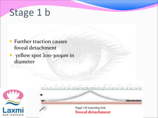 Stage 1 b
 Further traction causes
foveal detachment
 yellow spot ˆ200-300μm in
diameter
Foveal detachment
 