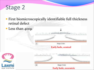 Stage 2
 First biomicroscopically identifiable full thickness
retinal defect
 Less than 400μ
Early hole, central
Early hole, eccentric
 