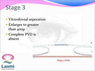 Stage 3
 Vitreofoveal seperation
 Enlarges to greater
than 400μ
 Complete PVD is
absent
Stage 3 Hole
 