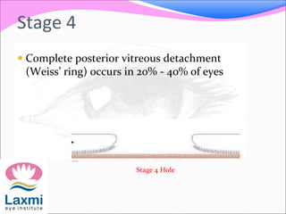 Stage 4
 Complete posterior vitreous detachment
(Weiss’ ring) occurs in 20% - 40% of eyes
Stage 4 Hole
 