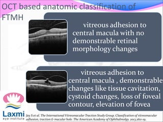 vitreous adhesion to
central macula with no
demonstrable retinal
morphology changes
vitreous adhesion to
central macula , demonstrable
changes like tissue cavitation,
cystoid changes, loss of foveal
contour, elevation of fovea
Jay S et al. The International Vitreomacular Traction Study Group. Classification of vitreomacular
adhesion, traction & macular hole. The American Academy of Ophthalmolgy. 2013.2611-19.
OCT based anatomic classification of
FTMH
 