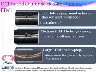 Small Hole ≥250μ, round or have a
f flap adherent to vitreous,
operculum ₊/-
Medium FTMH hole 250 - 400μ,
• round/ flap adherent to vitreous
Large FTMH hole >400μ,
• vitreous more likely to be fully seperated
• from macula
Jay S et al. The International Vitreomacular Traction Study Group. Classification of vitreomacular
adhesion, traction & macular hole. The American Academy of Ophthalmolgy. 2013.2611-19.
OCT based anatomic classification of
FTMH
 