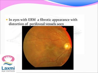  In eyes with ERM a fibrotic appearance with
distortion of perifoveal vessels seen
 