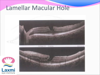 Lamellar Macular Hole
 