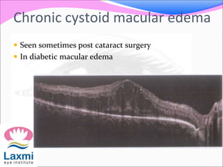 Chronic cystoid macular edema
 Seen sometimes post cataract surgery
 In diabetic macular edema
 