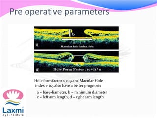 Pre operative parameters
Hole form factor > 0.9 and Macular Hole
index > 0.5 also have a better prognosis
a = base diameter, b = minimum diameter
c = left arm length, d = right arm length
 