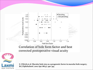Correlation of hole form factor and best
corrected postoperative visual acuity
S. Ullrich et al. Macular hole size as a prognostic factor in macular hole surgery.
Br J Ophthalmol. 2002 Apr; 86(4): 390–393
 
