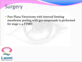 Surgery
 Pars Plana Vitrectomy with internal limiting
membrane peeling with gas tamponade is performed
for stage 2-4 FTMH
 