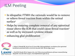  In idiopathic FTMH the rationale would be to remove
or relieve foveal traction from within the retinal
surface1
 Helps by ensuring complete removal of any epiretinal
tissue above the ILM that could cause foveal traction2
as well as by increased cytokine release
 enhancing glial proliferation
ILM Peeling
1- Fekrat S, Wendel RE, de la Cruz Z, Green WR: clinicopathologic correlation of an epiretinal
membrane associated with a recurrent macular hole. Retina 1995; 1:53-57
2- Yooh HS, Brooks HL Jr, Capone A Jr, et al. Ultra structural features of tissue removed during
idiopathic macular hole surgery. Am J Ophthalmol 1996;1:67-75
 