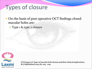 Types of closure
 On the basis of post operative OCT findings closed
macular holes are:
 Type 1 & type 2 closure
S W Kang et al. Types of macular hole closure and their clinical implications.
Br J Ophthalmol 2003; 87: 1015 - 1019
 