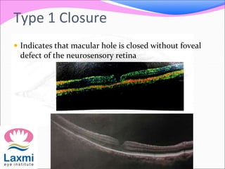 Type 1 Closure
 Indicates that macular hole is closed without foveal
defect of the neurosensory retina
 