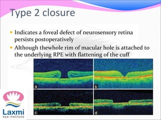 Type 2 closure
 Indicates a foveal defect of neurosensory retina
persists postoperatively
 Although thewhole rim of macular hole is attached to
the underlying RPE with flattening of the cuff
 