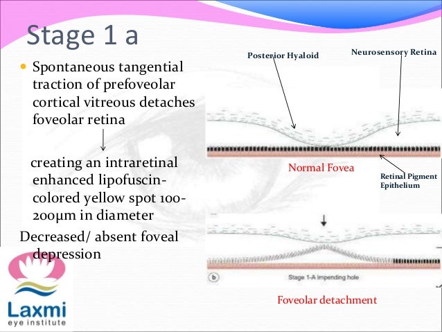 macular hole