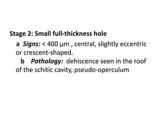 Stage 2: Small full-thickness hole
a Signs: < 400 µm , central, slightly eccentric
or crescent-shaped.
b Pathology: dehiscence seen in the roof
of the schitic cavity, pseudo-operculum
 