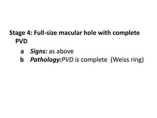 Stage 4: Full-size macular hole with complete
PVD
a Signs: as above
b Pathology:PVD is complete (Weiss ring)
 