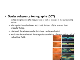 • Ocular coherence tomography (OCT)
– detect the presence of a macular hole as well as changes in the surrounding
retina.
– distinguish lamellar holes and cystic lesions of the macula from
macular holes.
– status of the vitreomacular interface can be evaluated
– evaluate the earliest of the stages & association of surrounding cuff of
subretinal fluid.
 