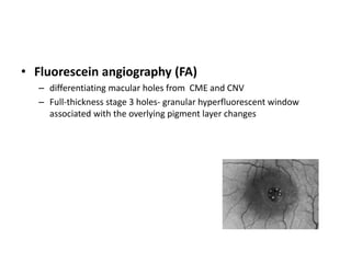 • Fluorescein angiography (FA)
– differentiating macular holes from CME and CNV
– Full-thickness stage 3 holes- granular hyperfluorescent window
associated with the overlying pigment layer changes
 