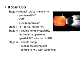 • B Scan USG
Stage I – retinal suface irregularity
- perifoveal PVD
- VMT
- pseudooperculum
Stage II – I + partial foveal PVD
Stage III – double hump irregularity
- echodense operculm
- partial PVD attached to OD
Stage IV – double hump
- echodense operculum
- complete PVD with weiss ring
 