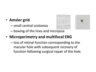 • Amsler grid
– small central scotomas
– bowing of the lines and micropsia
• Microperimetry and multifocal ERG
– loss of retinal function corresponding to the
macular hole with subsequent recovery of
function following surgical repair of the hole.
 