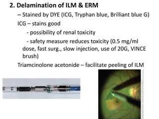 2. Delamination of ILM & ERM
– Stained by DYE (ICG, Tryphan blue, Brilliant blue G)
ICG – stains good
- possibility of renal toxicity
- safety measure reduces toxicity (0.5 mg/ml
dose, fast surg., slow injection, use of 20G, VINCE
brush)
Triamcinolone acetonide – facilitate peeling of ILM
 