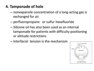 4. Tamponade of hole
– nonexpansile concentration of a long-acting gas is
exchanged for air
– perfluoropropane or sulfur hexafluoride
– Silicone oil has also been used as an internal
tamponade for patients with difficulty positioning
or altitude restrictions
– Interfacial tension is the mechanism
 