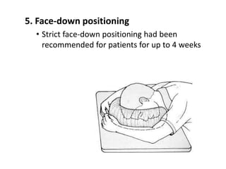 5. Face-down positioning
• Strict face-down positioning had been
recommended for patients for up to 4 weeks
 