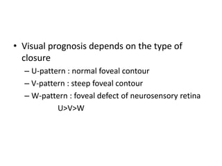 • Visual prognosis depends on the type of
closure
– U-pattern : normal foveal contour
– V-pattern : steep foveal contour
– W-pattern : foveal defect of neurosensory retina
U>V>W
 