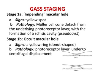 GASS STAGING
Stage 1a: ‘Impending’ macular hole
a Signs: yellow spot
b Pathology: Müller cell cone detach from
the underlying photoreceptor layer, with the
formation of a schisis cavity (pseudocyst)
Stage 1b: Occult macular hole
a Signs: a yellow ring (donut-shaped)
b Pathology: photoreceptor layer undergo
centrifugal displacement
 