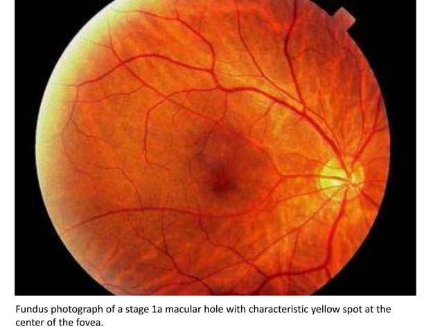 Macular hole | PPTX | Eye and Vision Conditions | Diseases and Conditions