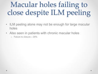 Macular holes failing to
close despite ILM peeling
• ILM peeling alone may not be enough for large macular
holes
• Also seen in patients with chronic macular holes
o Failure to closure – 20%
 