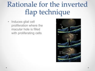 Rationale for the inverted
flap technique
• Induces glial cell
proliferation where the
macular hole is filled
with proliferating cells
 