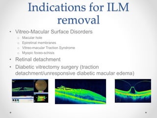 Indications for ILM
removal
• Vitreo-Macular Surface Disorders
o Macular hole
o Epiretinal membranes
o Vitreo-macular Traction Syndrome
o Myopic foveo-schisis
• Retinal detachment
• Diabetic vitrectomy surgery (traction
detachment/unresponsive diabetic macular edema)
 