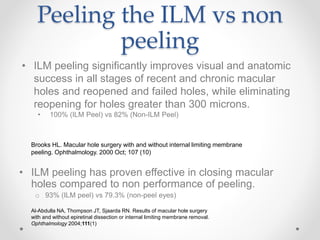 Peeling the ILM vs non
peeling
• ILM peeling has proven effective in closing macular
holes compared to non performance of peeling.
o 93% (ILM peel) vs 79.3% (non-peel eyes)
Al-Abdulla NA, Thompson JT, Sjaarda RN. Results of macular hole surgery
with and without epiretinal dissection or internal limiting membrane removal.
Ophthalmology 2004;111(1)
• ILM peeling significantly improves visual and anatomic
success in all stages of recent and chronic macular
holes and reopened and failed holes, while eliminating
reopening for holes greater than 300 microns.
• 100% (ILM Peel) vs 82% (Non-ILM Peel)
Brooks HL. Macular hole surgery with and without internal limiting membrane
peeling. Ophthalmology. 2000 Oct; 107 (10)
 