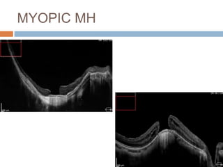 MYOPIC MH
 