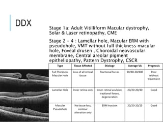 DDX Stage 1a: Adult Vitilliform Macular dystrophy,
Solar & Laser retinopathy, CME
Stage 2 – 4 : Lamellar hole, Macular ERM with
pseudohole, VMT without full thickness macular
hole, Foveal drusen , Choroidal neovascular
membrane, Central areolar pigment
epitheliopathy, Pattern Dystrophy, CSCR
 