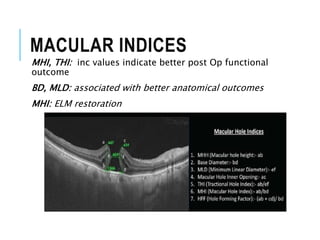 MACULAR INDICES
MHI, THI: inc values indicate better post Op functional
outcome
BD, MLD: associated with better anatomical outcomes
MHI: ELM restoration
 