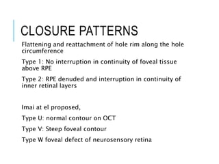 CLOSURE PATTERNS
Flattening and reattachment of hole rim along the hole
circumference
Type 1: No interruption in continuity of foveal tissue
above RPE
Type 2: RPE denuded and interruption in continuity of
inner retinal layers
Imai at el proposed,
Type U: normal contour on OCT
Type V: Steep foveal contour
Type W foveal defect of neurosensory retina
 