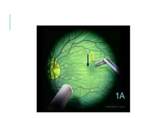 macular hole.pptx