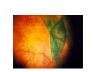 macular hole.pptx