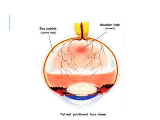 macular hole.pptx