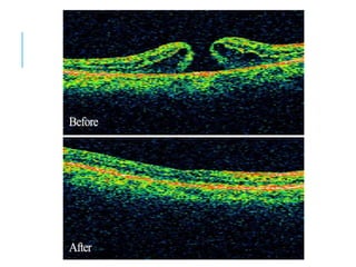 macular hole.pptx