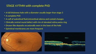 MACULAR HOLE.DIAGNOSIS .CLINICAL FEATURES.MANAGEMENT | PPTX